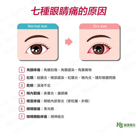 眼角痛|7種眼睛痛可能原因？常見眼睛疾病介紹、保健、飲食一次看